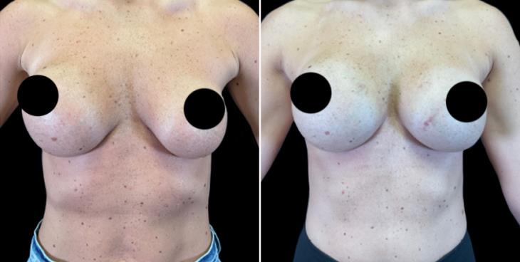 Breast Implant Replacement Case